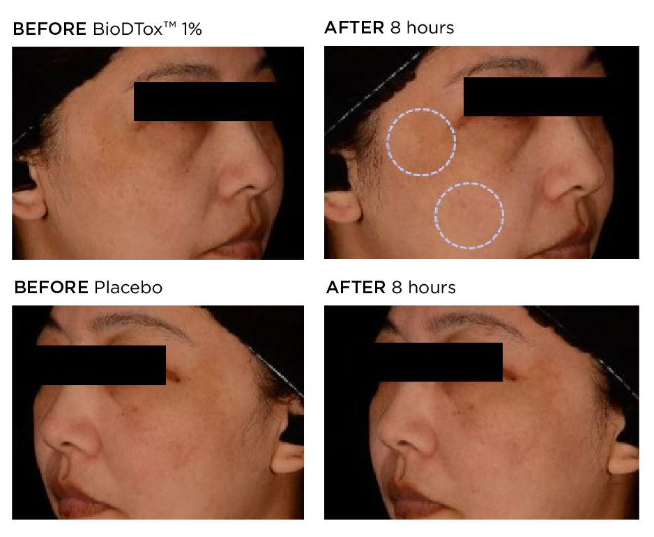 The images show a comparison of ears before and after a procedure. The "before" images display ears with a more prominent or protruding appearance, while the "after" images show ears that lie closer to the head, indicating a reduction in prominence. This suggests that the procedure performed is likely an otoplasty, which is a cosmetic surgery to change the shape, position, or size of the ears. The results demonstrate a more streamlined and less protruding ear contour.