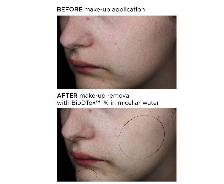 The images show a comparison of skin condition before and after treatment with BioBtox 1% in micellar water. The "before" image displays visible skin imperfections such as redness and blemishes on the cheek and chin areas. The "after" image shows a noticeable improvement in skin texture and tone, with reduced redness and fewer blemishes, indicating the effectiveness of the treatment. The circled areas highlight the specific regions where the improvement is most evident.